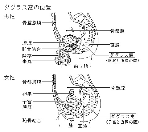 虫垂炎 虫垂突起炎 盲腸炎とは コトバンク