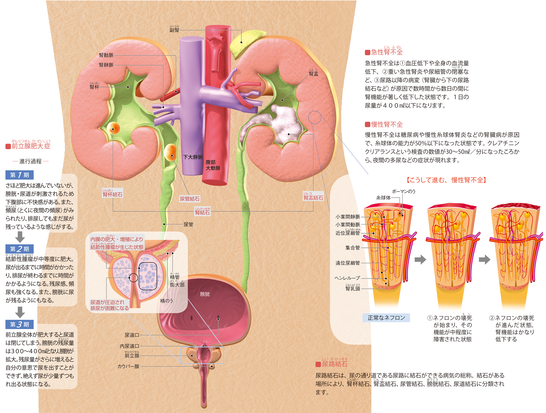 前立腺肥大症とは何ですか?