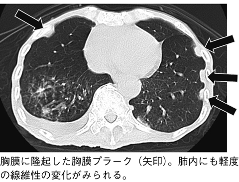 珪肺症の長期的な見通しはどうなりますか?