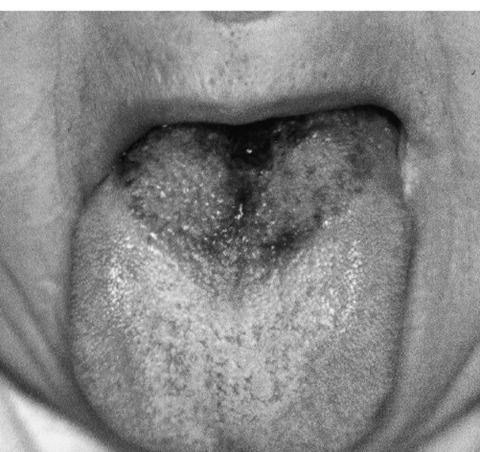 舌 黒毛 黒毛舌：病因、症状、治療と予防