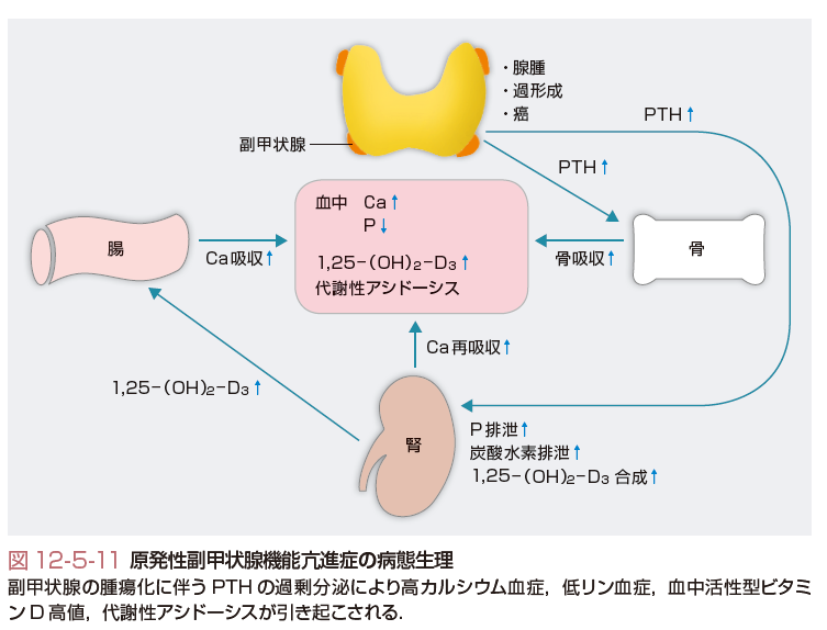 副甲状腺機能亢進症は不眠症を引き起こしますか?